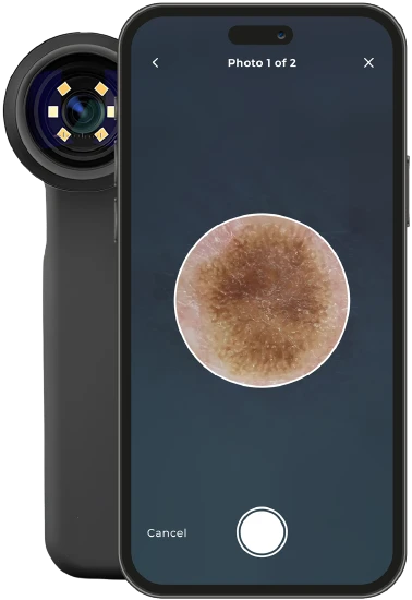 Phone showing mole screening example